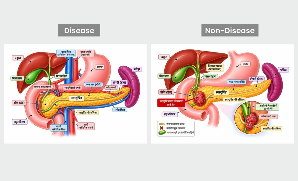 Pancreatic Cancer